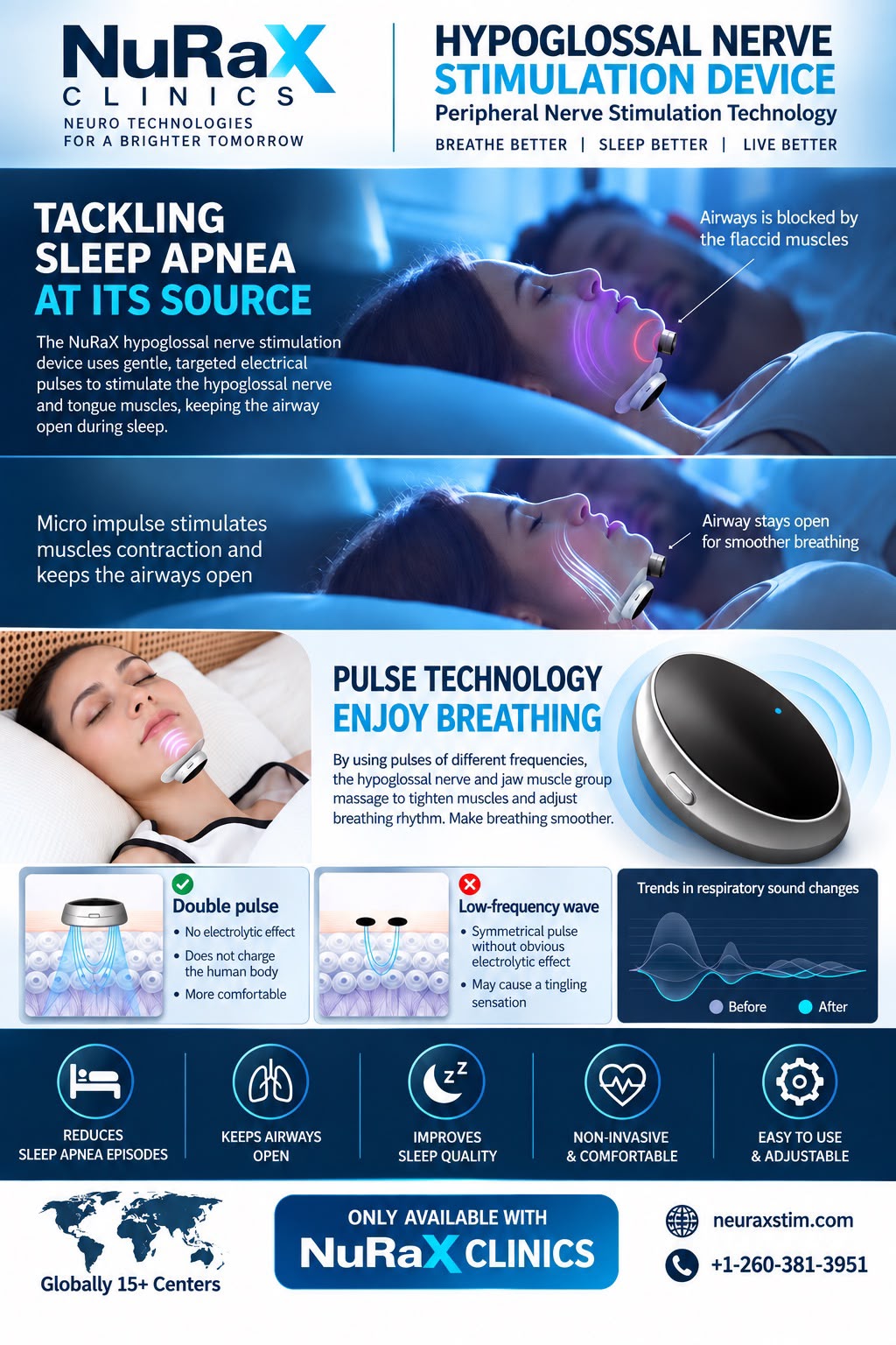 Hypoglossal Nerve Stimulation Device — Sleep Apnea